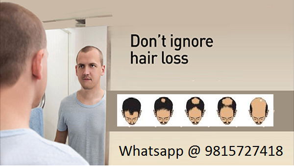 Hair Transplant Punjab | Hair Loss Treatment Punjab | FUE Hair Transplant  Punjab | Punjab Hair Transplant Clinic | Hair Transplant Surgery Punjab
