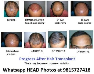 2-1 - Chandigarh Hair Transplantation