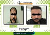 results of hair transplant in india