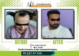 results of hair transplant