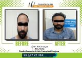 hair transplant results in india