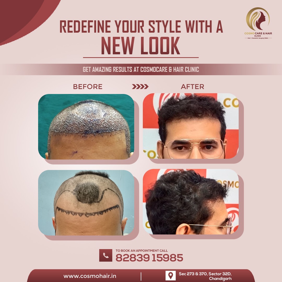 Hair Transplant in Chandigarh | Cost of Hair Transplant in Chandigarh -  YouTube