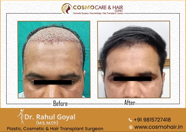 3 - Chandigarh Hair Transplantation