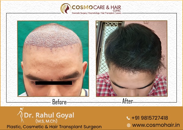 40 - Chandigarh Hair Transplantation