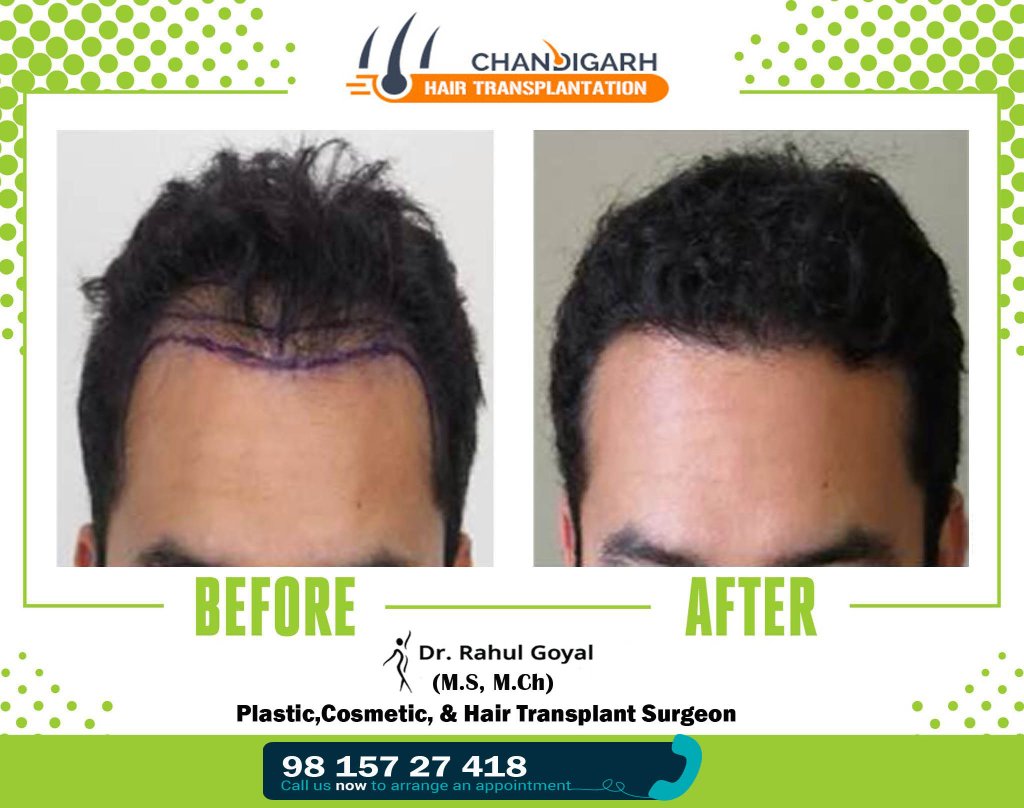 Before-After frame 14 - Chandigarh Hair Transplantation