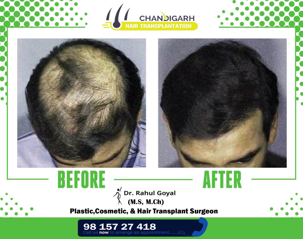 Before-After frame 15 - Chandigarh Hair Transplantation