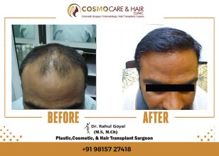 before-after20 - Chandigarh Hair Transplantation