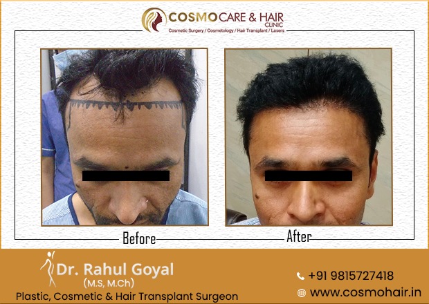 25 - Chandigarh Hair Transplantation