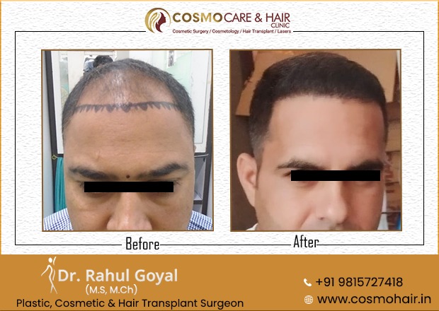 26 - Chandigarh Hair Transplantation
