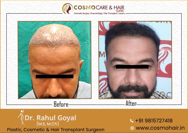 21  Chandigarh Hair Transplantation