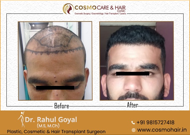 33 - Chandigarh Hair Transplantation