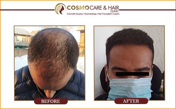 hair transplant result chandigarh