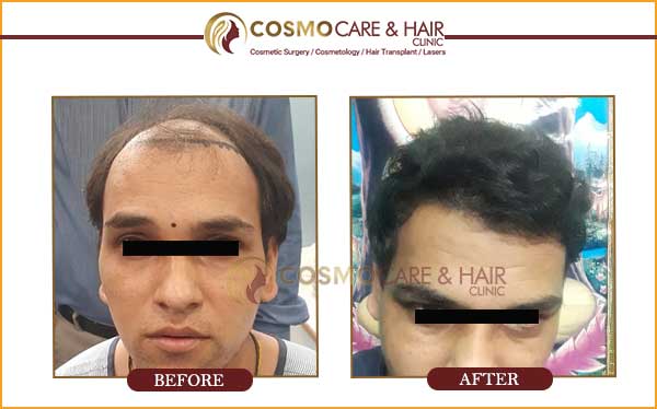 Cosmo hair transplant chandigarh
