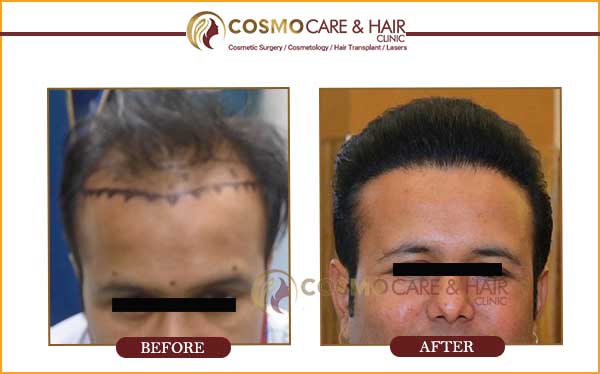 Chandigarh hair transplant best result