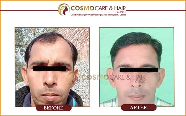 Best Hair Transplant in Chandigarh | Chandigarh Hair Transplantation