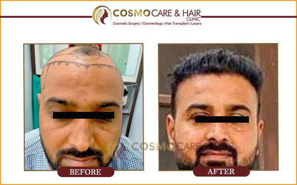 ranjit-result-hairtransplant