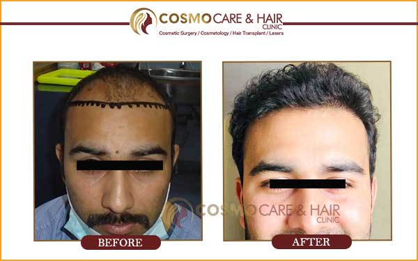5 Best Clinics for (Hair Transplant in Chandigarh) With Cost & All Details