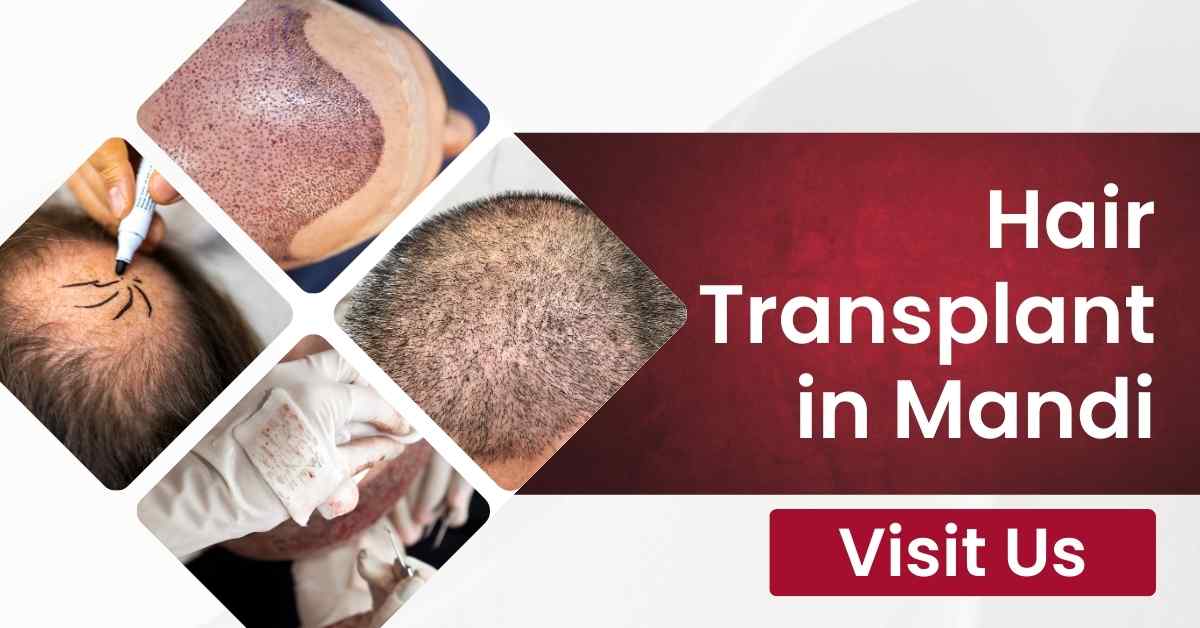 Hair Transplant in Mandi