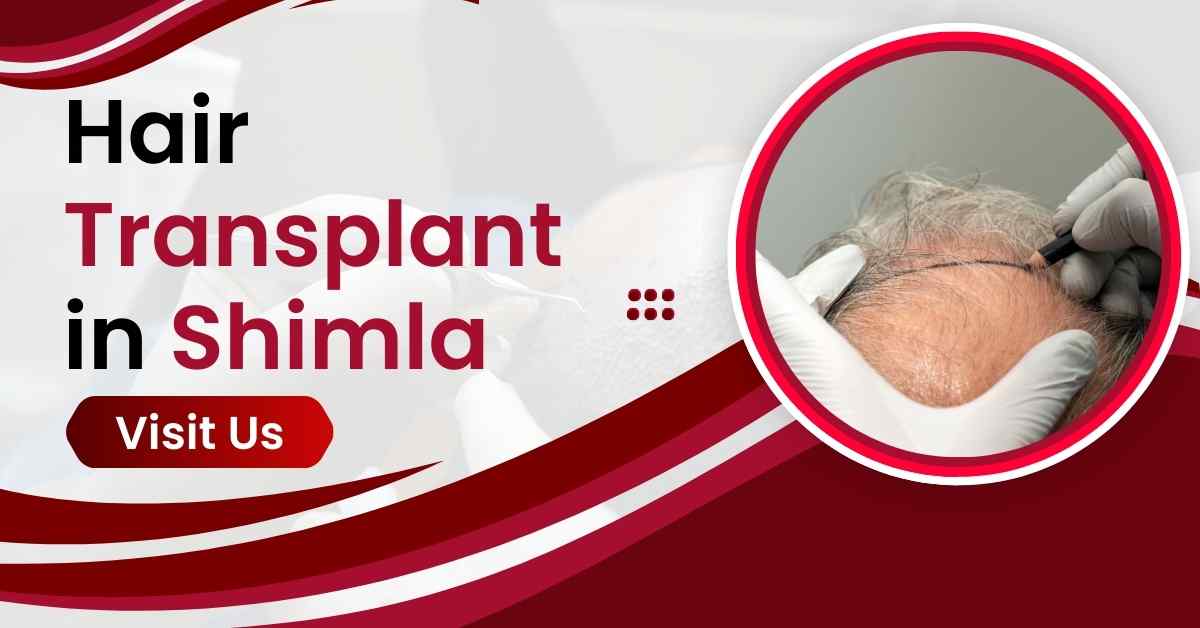 Hair Transplant in Shimla