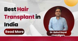Best Hair Transplant in India