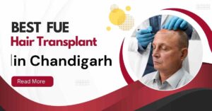 Best FUE Hair Transplant