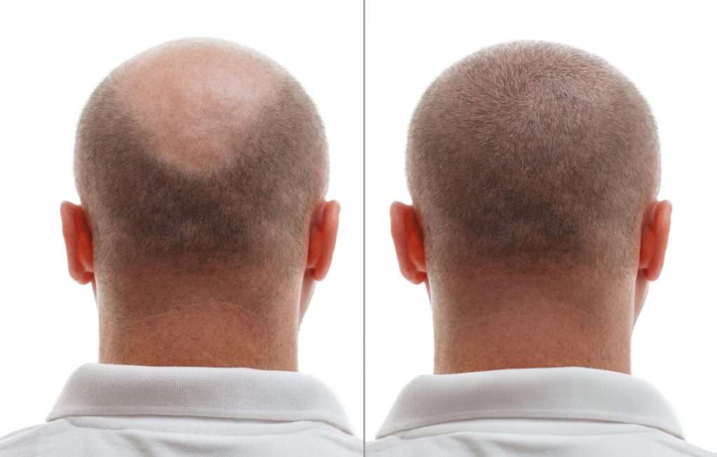 cosmocare and hair clinic hair transplant before and after