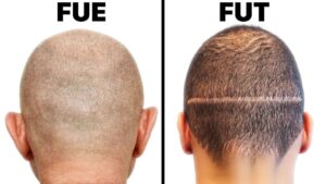 fue and fut hair transplant