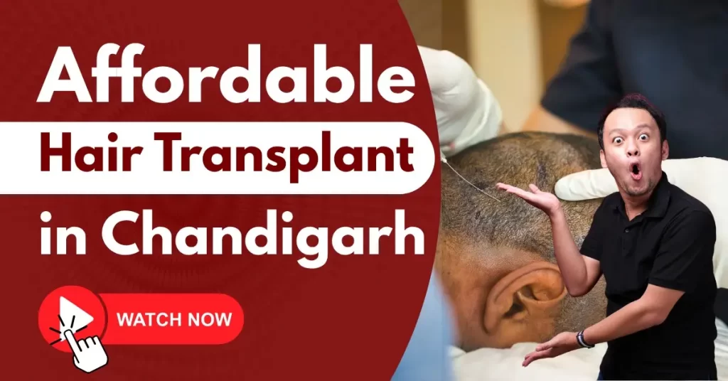 Affordable Hair Transplant in Chandigarh