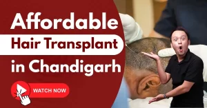 Read more about the article Affordable Hair Transplant in Chandigarh