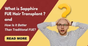 Read more about the article What is Sapphire FUE Hair Transplant and How Is It Better Than Traditional FUE? 