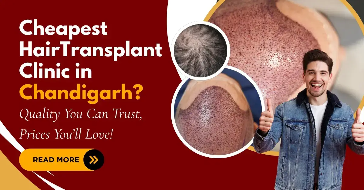 Read more about the article Cheapest Hair Transplant Clinic in Chandigarh