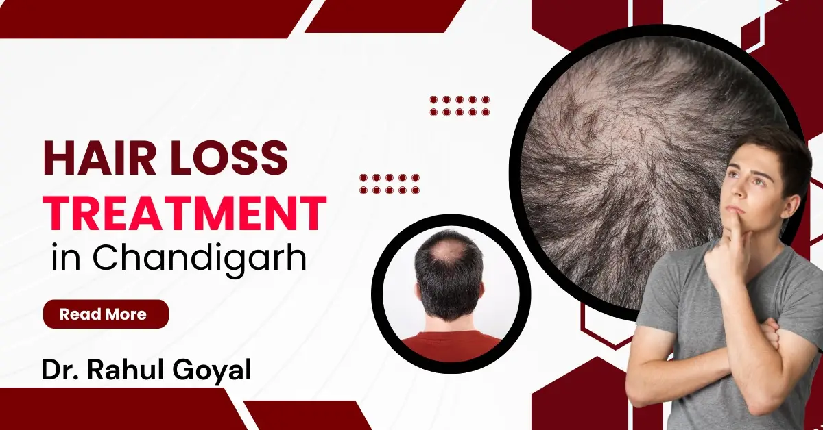 You are currently viewing Hair Loss Treatment in Chandigarh – Restoring Your Confidence