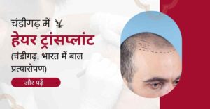 चंडीगढ़ में हेयर ट्रांसप्लांट (चंडीगढ़, भारत में बाल प्रत्यारोपण)