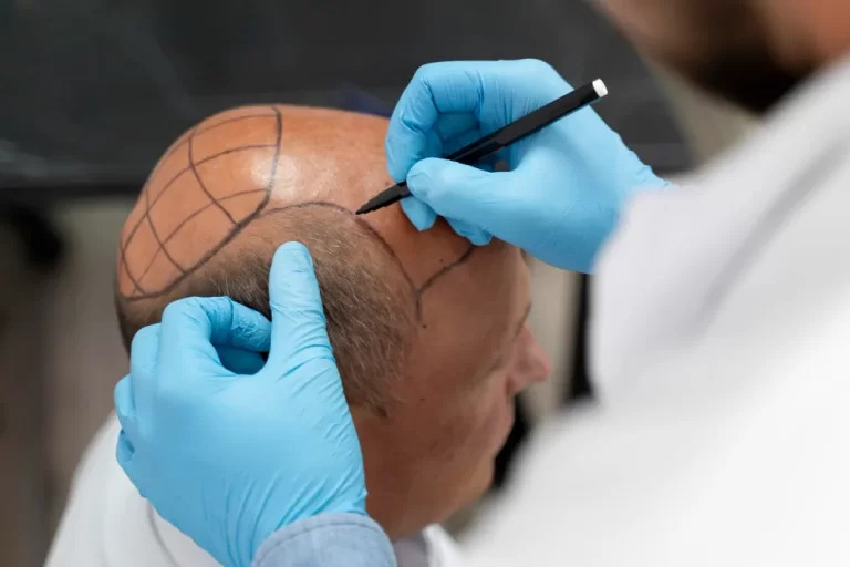 Hair Transplant Procedure
