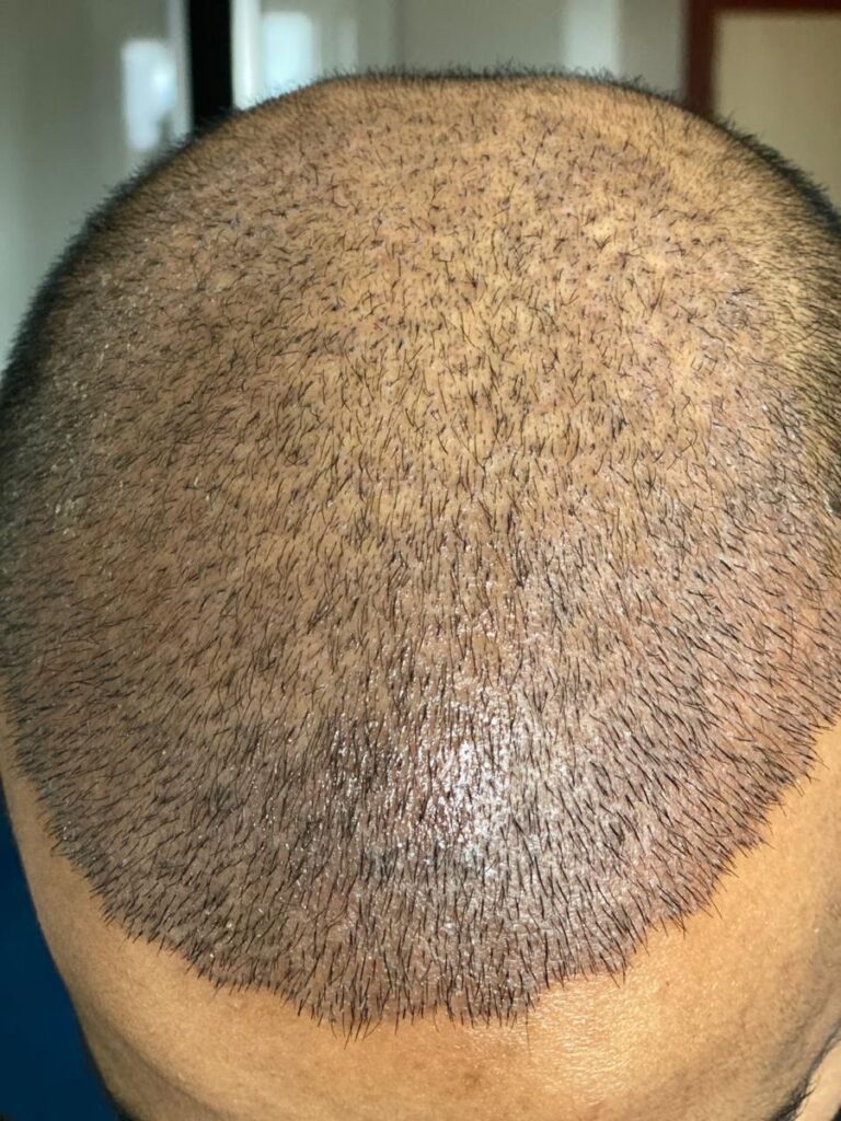 cosmocare and hair clinic hair transplant before and after
