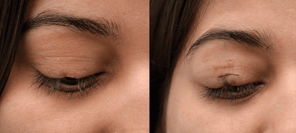 Eyelash Hair Transplant in Chandigarh before after