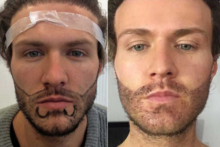 Beard Hair Transplant in Chandigarh