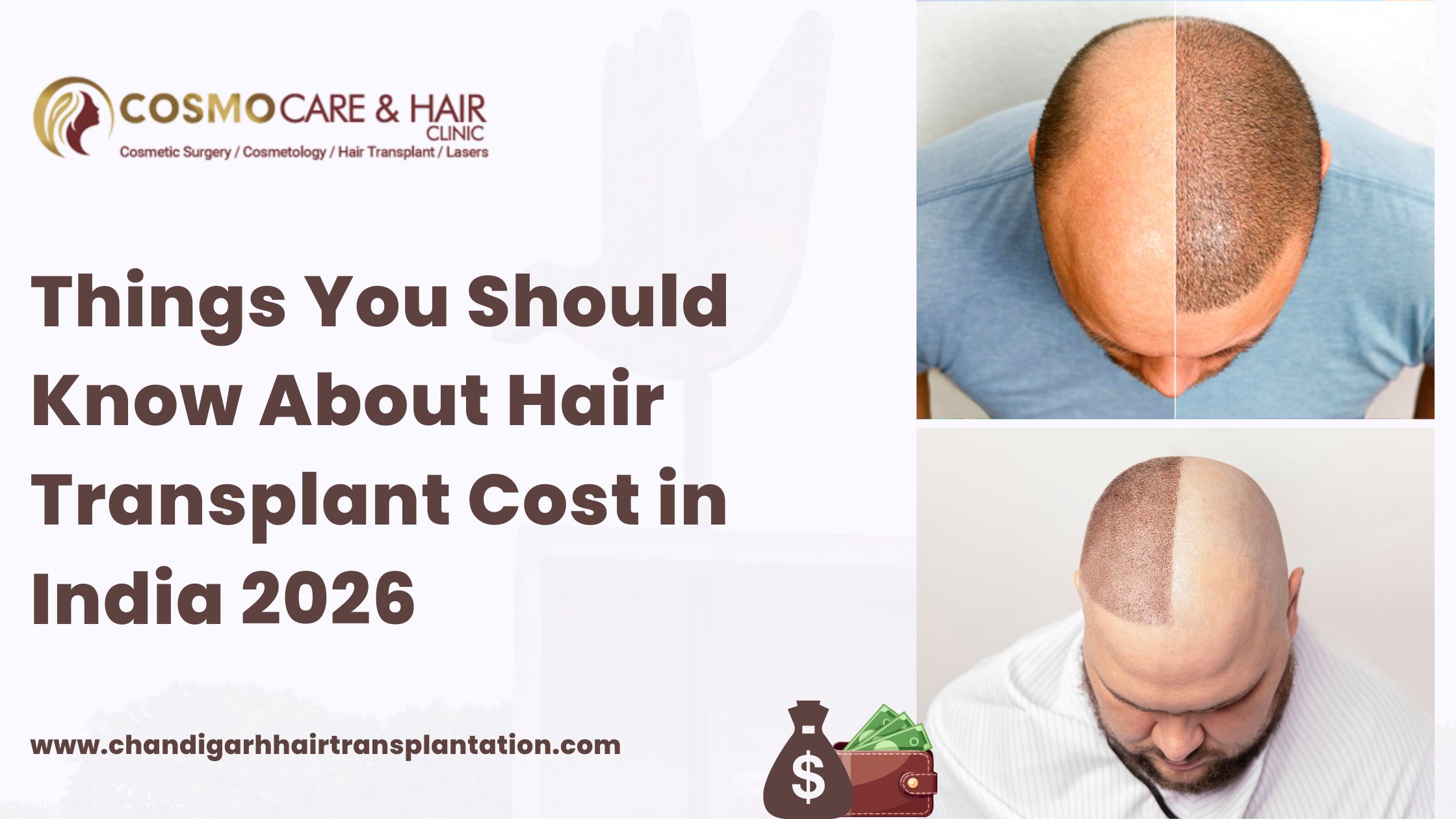 Hair Transplant Cost in India 2026