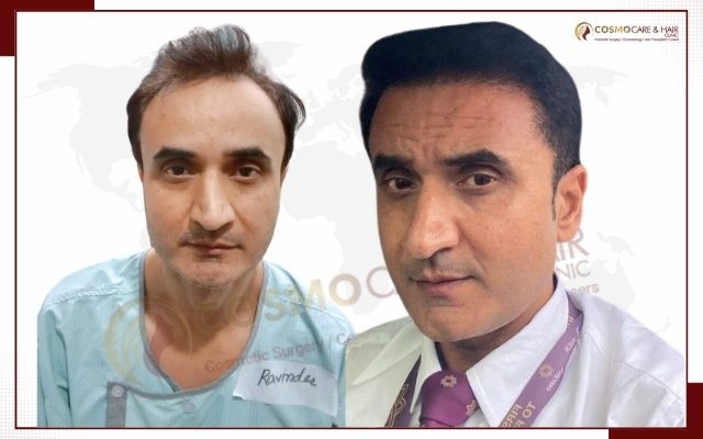 Hair Transplant Clinic In Chandigarh