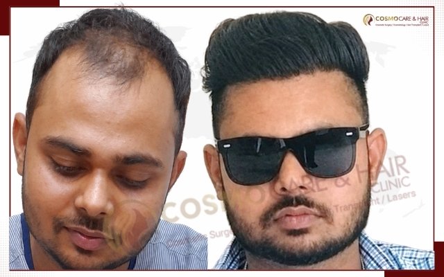 Hair Transplant In Chandigarh