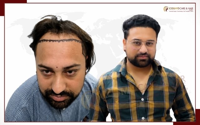 Hair Transplant Clinic In Chandigarh
