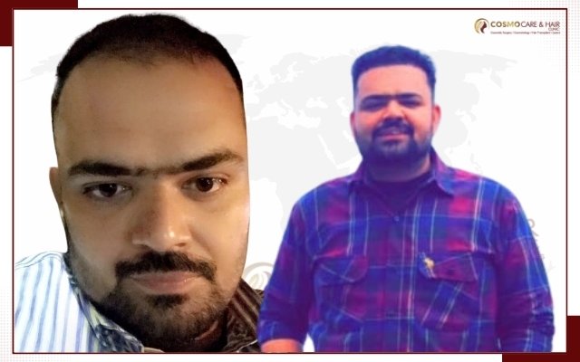 Best Hair Transplant In Chandigarh