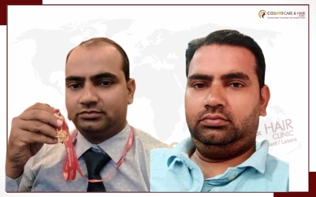 Hair Transplant In Chandigarh