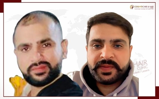 Hair Transplant Clinic In Chandigarh