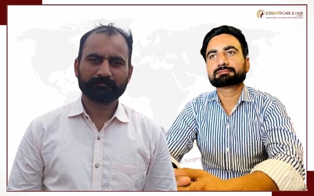 Hair Transplant Doctor In Chandigarh