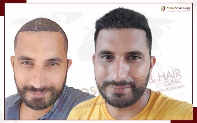 Hair Transplant In Chandigarh