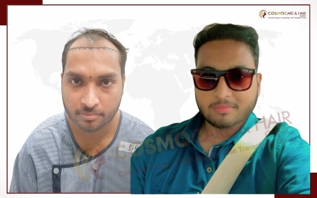 Hair Transplant In Chandigarh