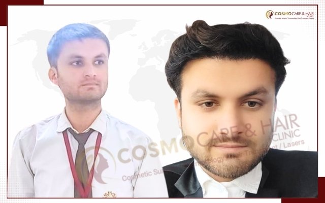 Best Hair Transplant In Chandigarh