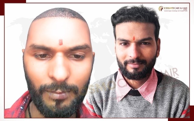 Best Hair Transplant In Chandigarh