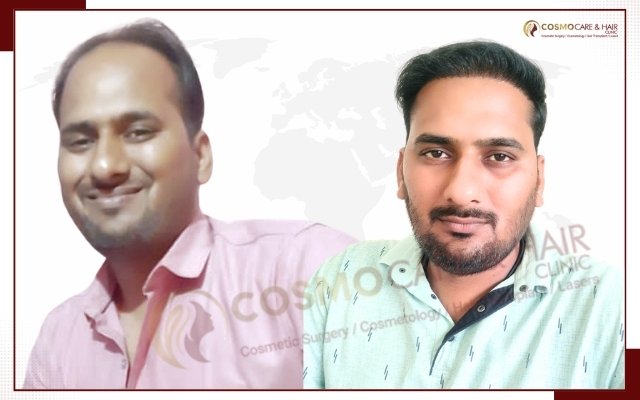 Hair Transplant Doctor In Chandigarh